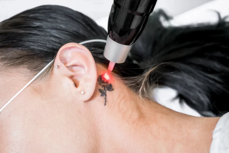Laser-Tattooentfernung